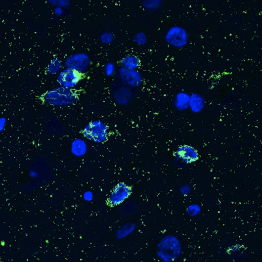 Pathological deposits of the protein TDP-43 (green) in the nuclei of neurons (blue).