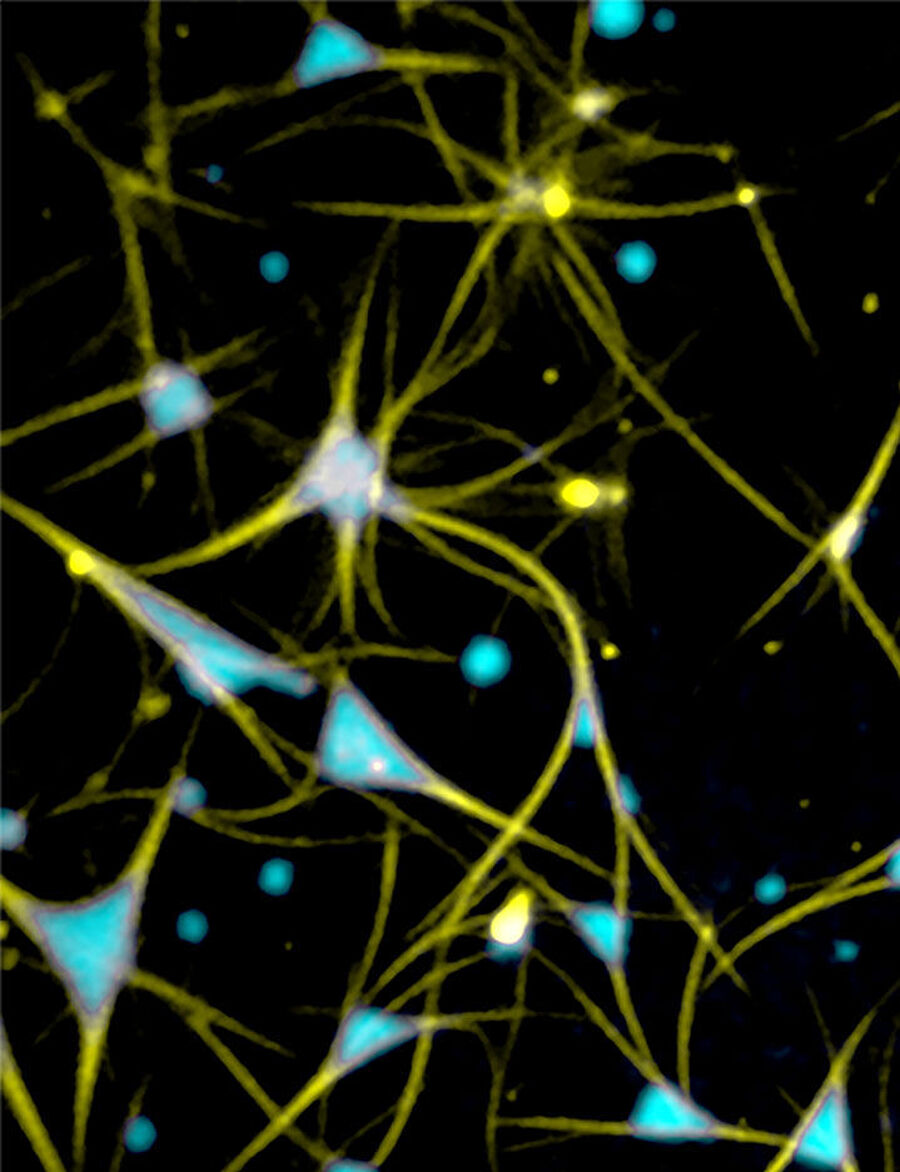 Mikroskopische Aufnahme von in vitro zusammengesetzten Mikrotubuli-Bündel mit Tau-Kondensaten.