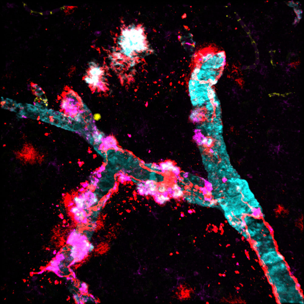 Mikroskopische Aufnahme eines Blutgefäß des Gehirns mit Protein-Ablagerungen. 