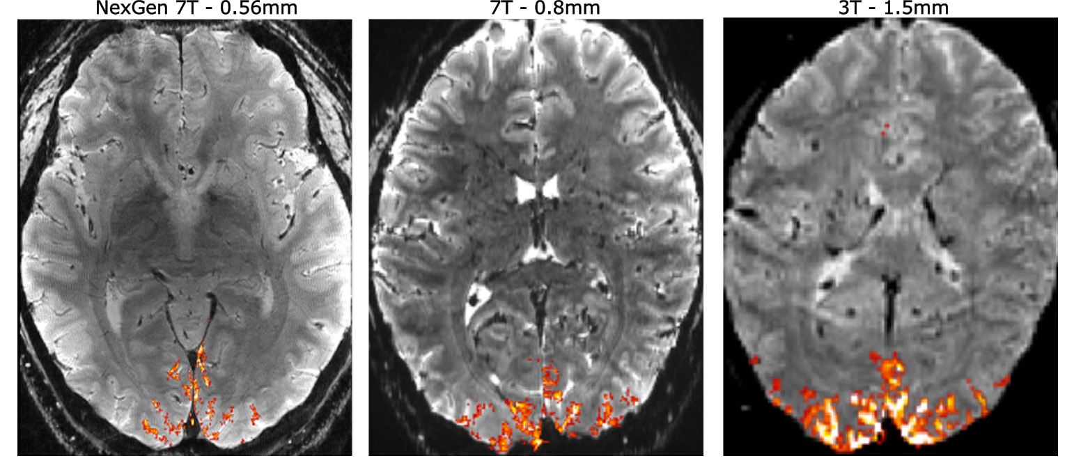 Bild zeigt Scans des menschlichen Gehirns aufgezeichnet mit unterschiedlichen MRT-Geräten.