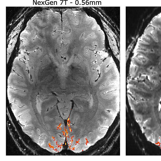 Bild zeigt Scans des menschlichen Gehirns aufgezeichnet mit unterschiedlichen MRT-Geräten.