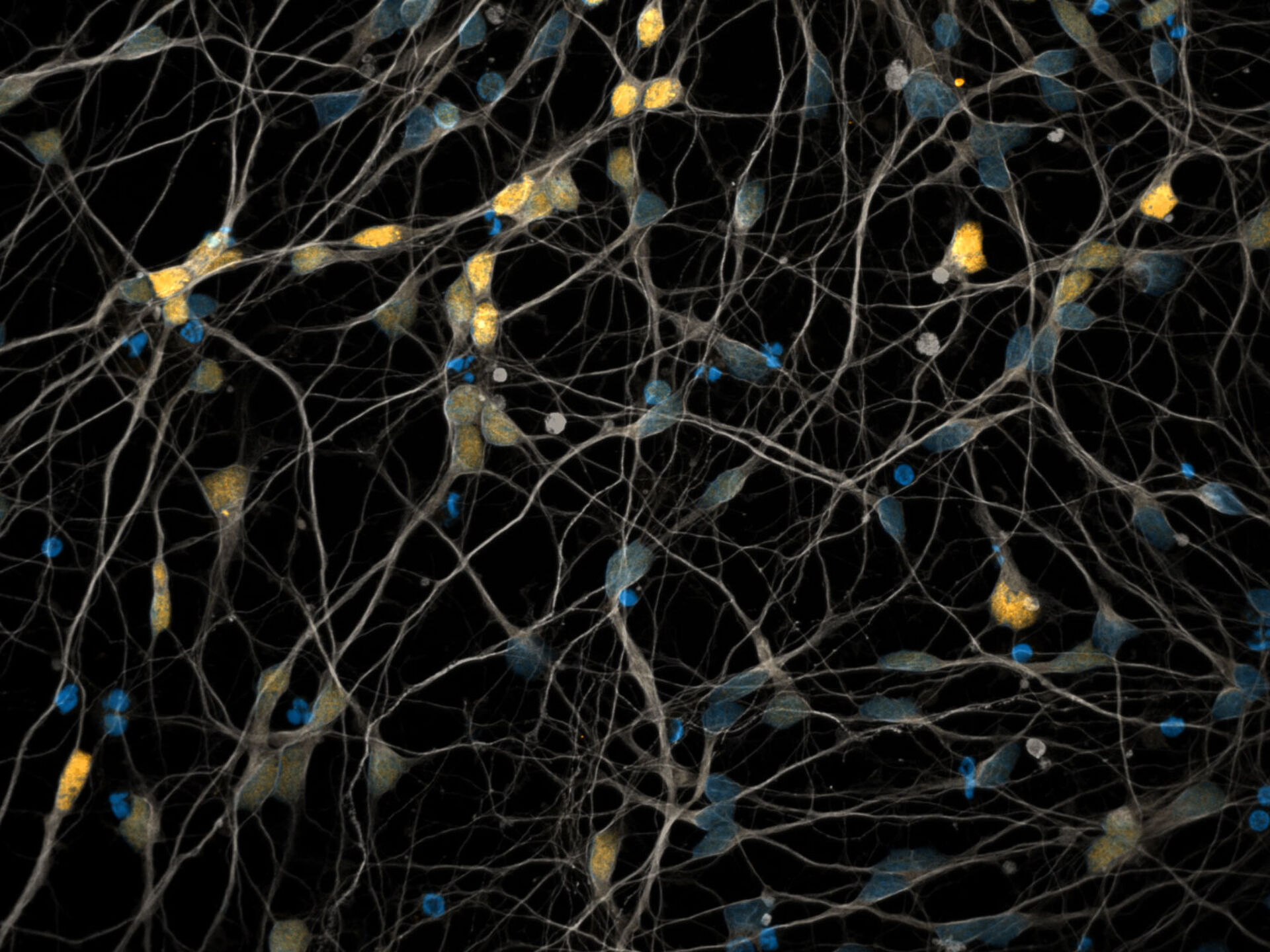 Bild zeigt mikroskopische Aufnahme neuronaler Zellkulturen von SCA3-Patienten mit farblich markierten Zellen.