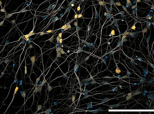 Bild zeigt mikroskopische Aufnahme neuronaler Zellkulturen von SCA3-Patienten mit farblich markierten Zellen.