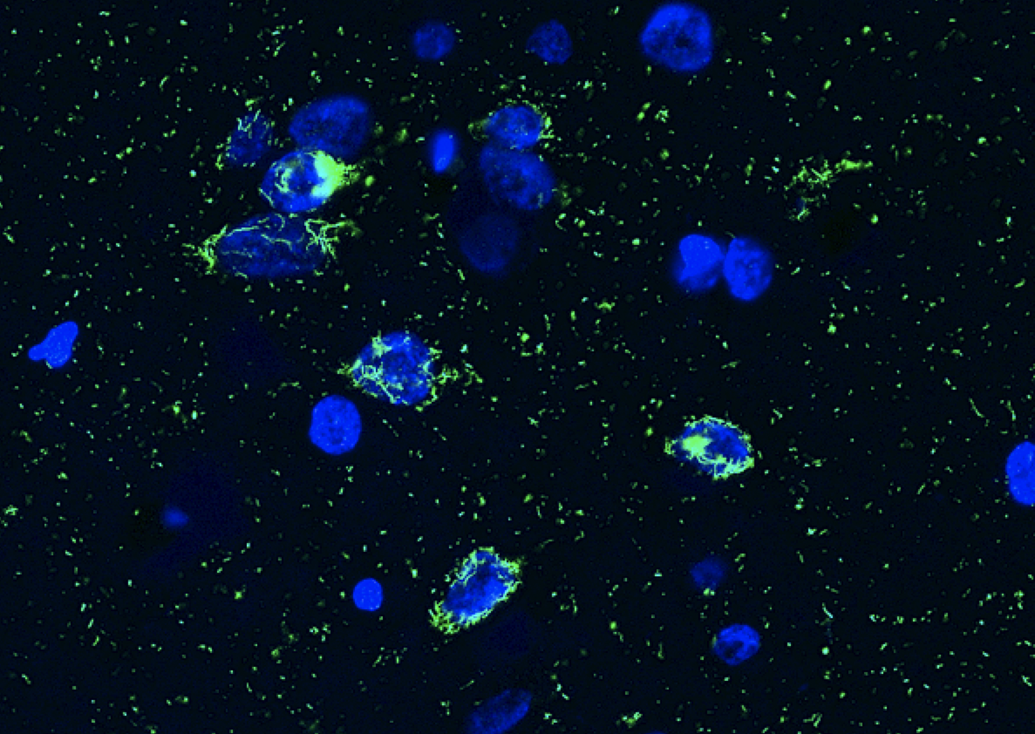 Pathological deposits of the protein TDP-43 (green) in the nuclei of neurons (blue).