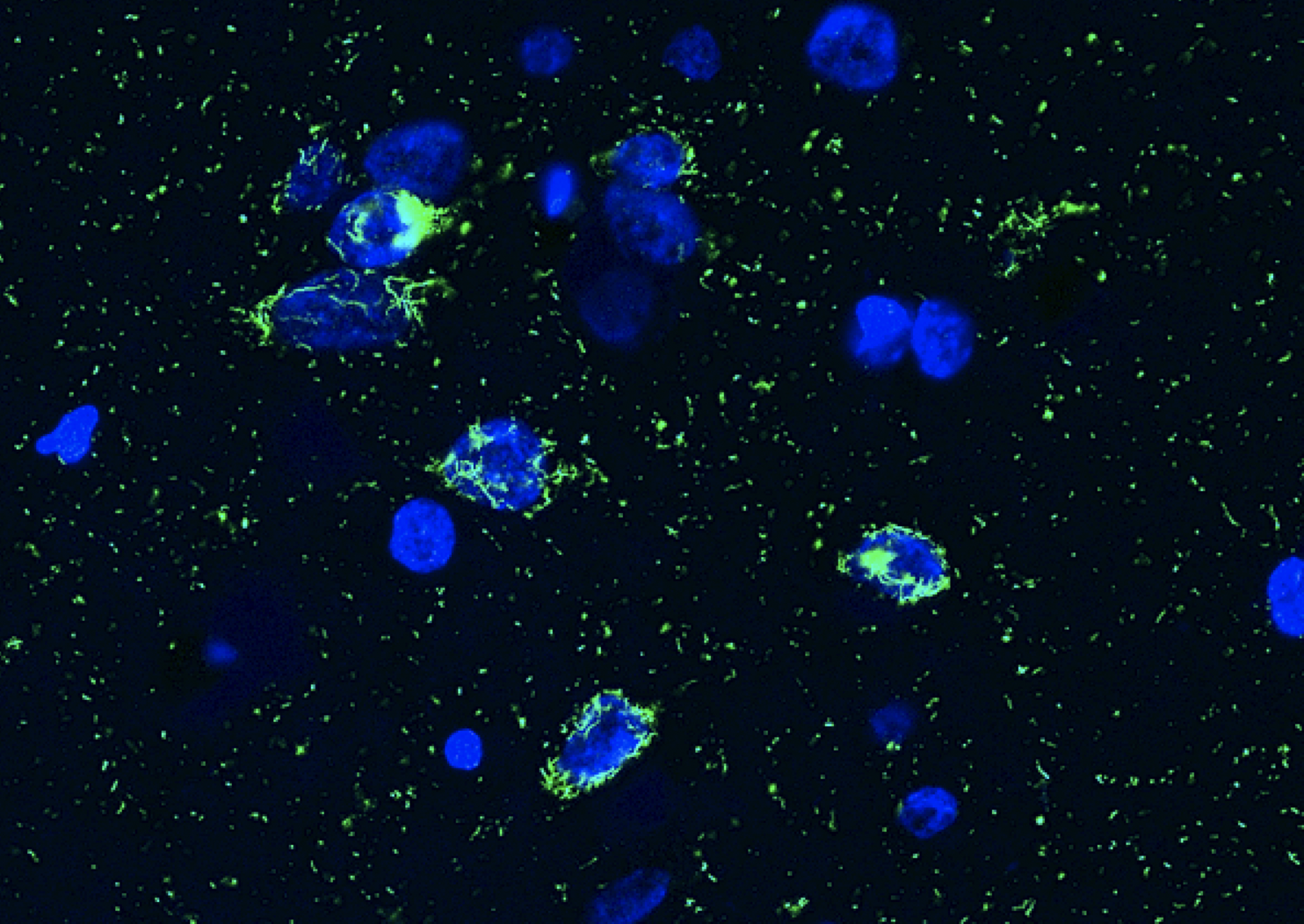 Krankhafte Ablagerungen des Proteins TDP-43 (grün) in den Zellkernen von Nervenzellen (blau).