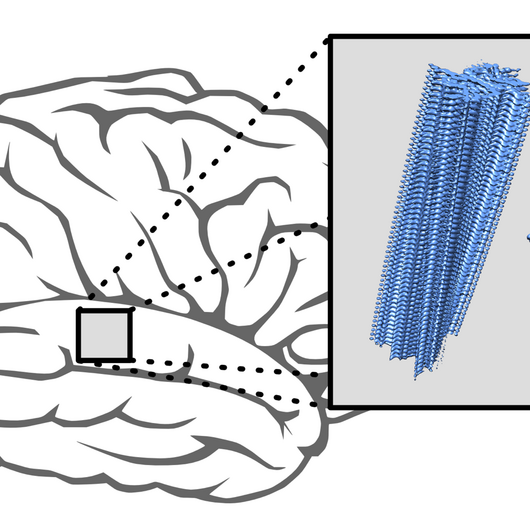 In Parkinson’s and multisystem atrophy, proteins accumulate in layers to form elongated aggregates (blue) that are deposited in the brain.