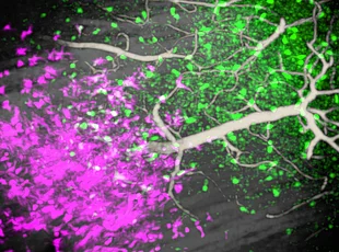 Bild zeigt Zusammenspiel mehrerer Glioblastomzellen in magenta markiert und Immunzellen grün markiert im Gehirn einer lebenden Maus.
