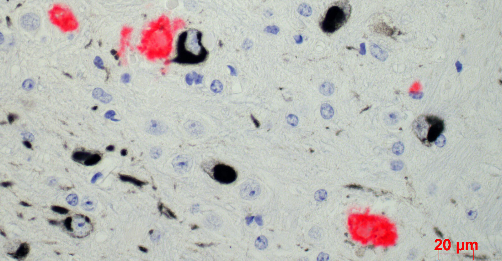 Image shows brain tissue with plaques of beta-amyloid proteins (red) under the microscope