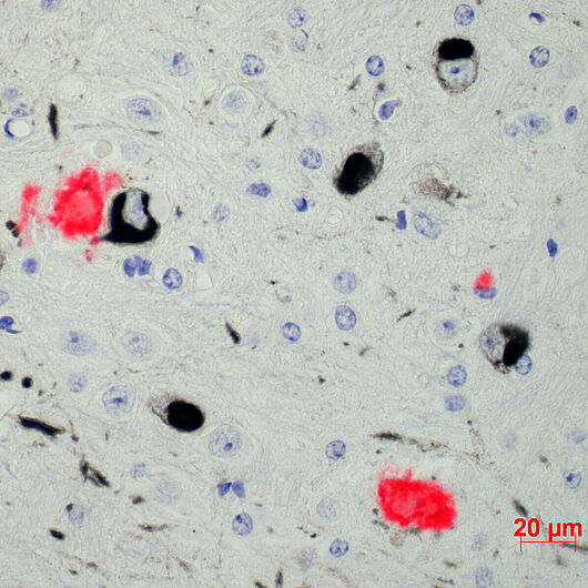 Bild zeigt rot eingefärbt Hirngewebe mit Ablagerungen von Beta-Amyloid-Eiweißen unter dem Mikroskop