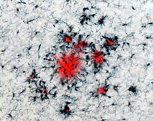 This image shows such immune cells (in black) clustered around plaques (in red), which are insoluble protein deposits characteristic of Alzheimer’s disease. 